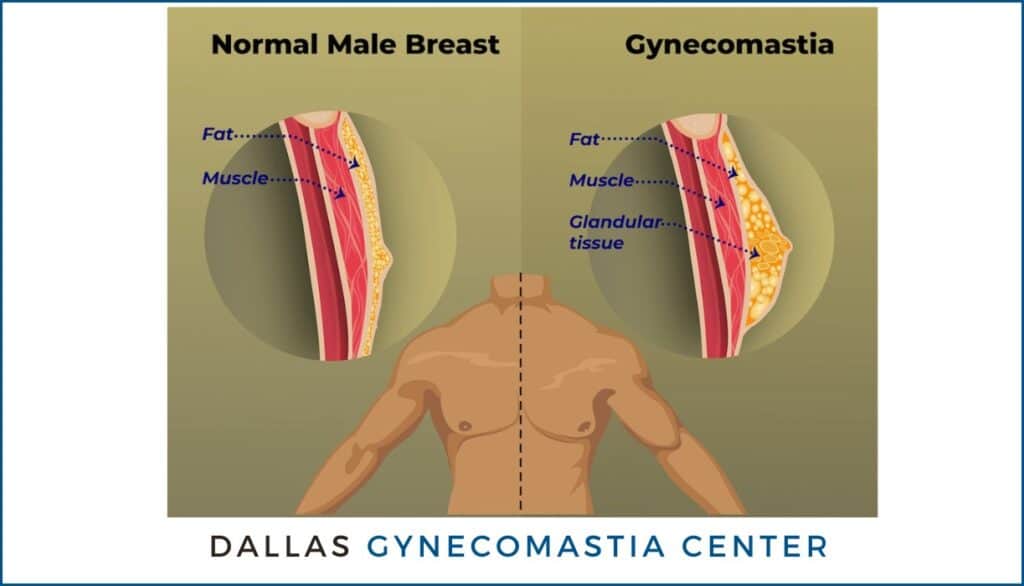 Dallas Gynecomastia