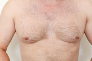 Gynecomastia Candidates Dallas